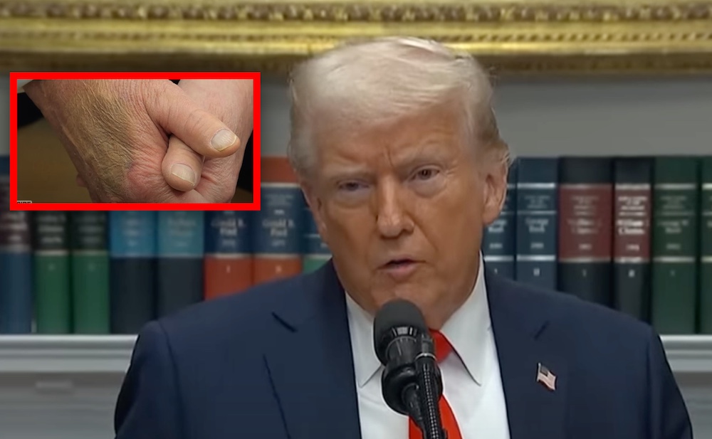 Zauważono dziwne ślady na dłoni Trumpa. Dziwaczne tłumaczenia Białego Domu. „Codziennie ściska…”